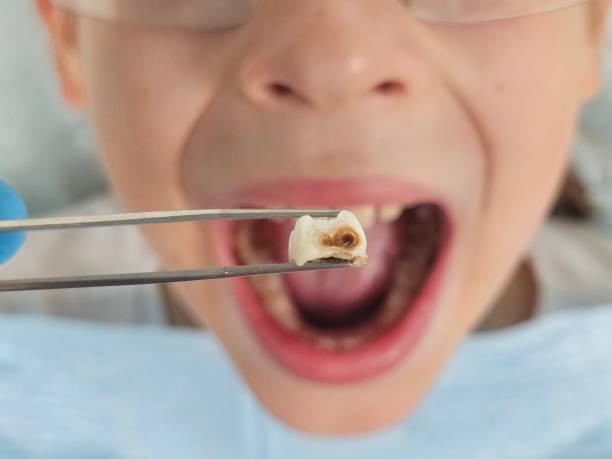 Best Emergency Root Canal Treatment in Woodlake, VA