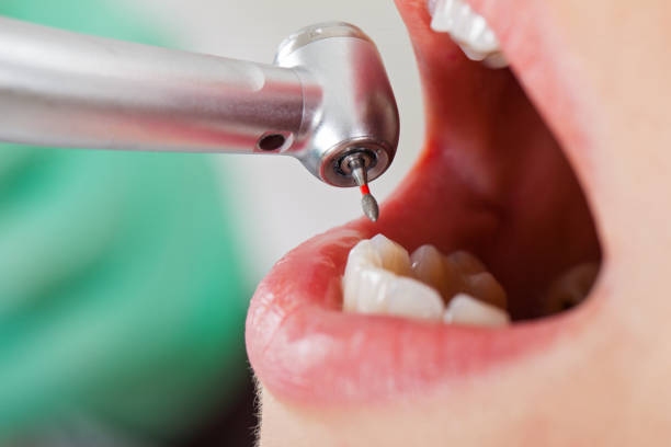 Best Emergency Tooth Extraction in Woodlake, VA